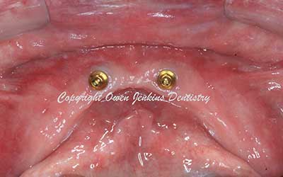 Lower Implant Denture