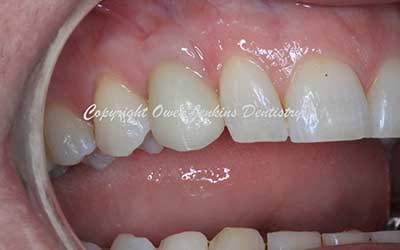 Replacement of retained baby teeth with implants