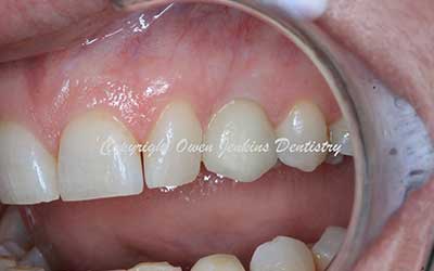 Replacement of retained baby teeth with implants