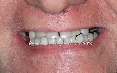 Upper Implant Denture