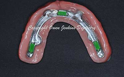 Upper Implant Denture